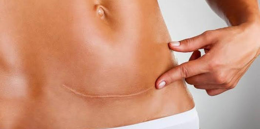 GREAT C-SECTION TIPS AND RECOMMENDATIONS – PART TWO